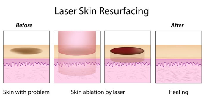 Erbium Laser Skin Resurfacing by OrangeCountySurgeons